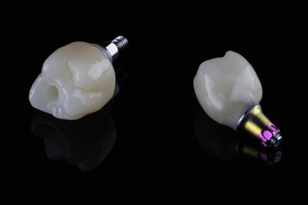 How Natural Does An Implant Crown Look?
